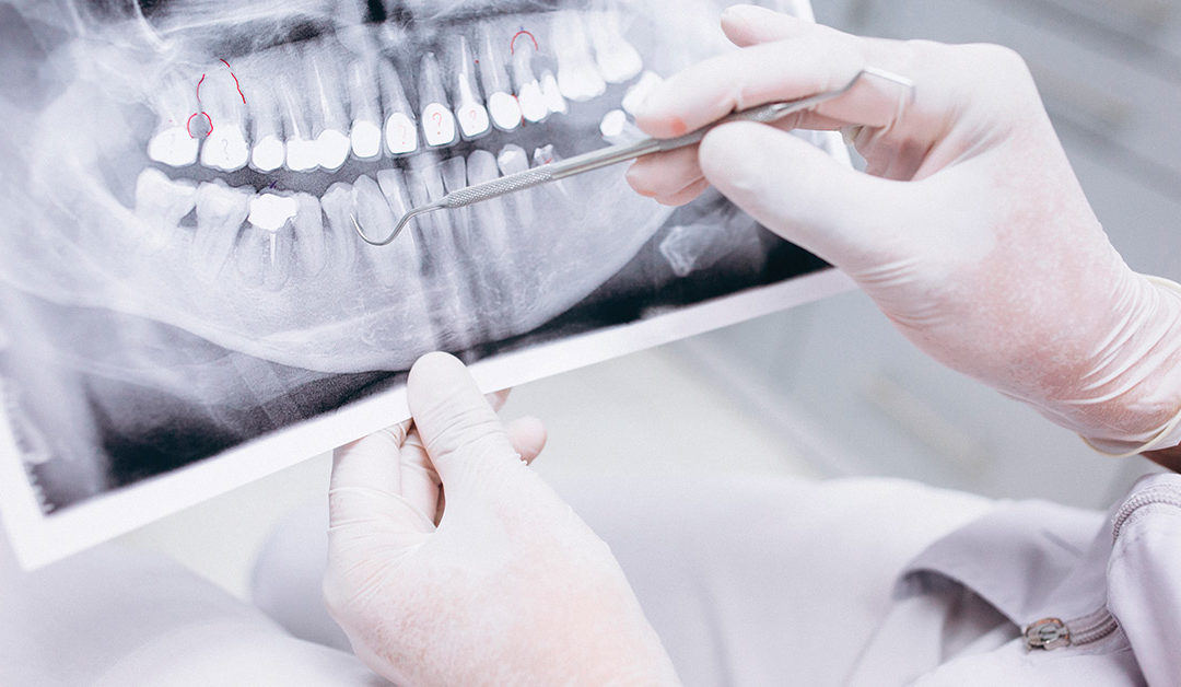 Por qué es importante tratar las enfermedades dentales